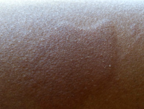 Child with Urticaria
