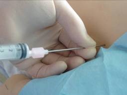 A gloved hand gripping the access needle between thumb and index finger 1cm from its tip.