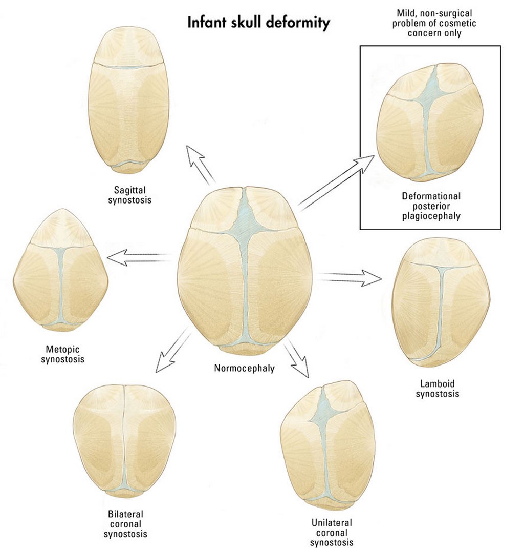 Infant skull deformity illustration