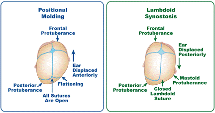 Positional Plagiocephaly illustration