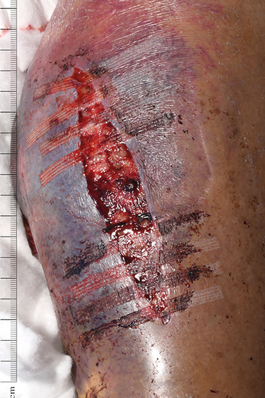 Sutures
