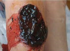 Open bleeding haematoma