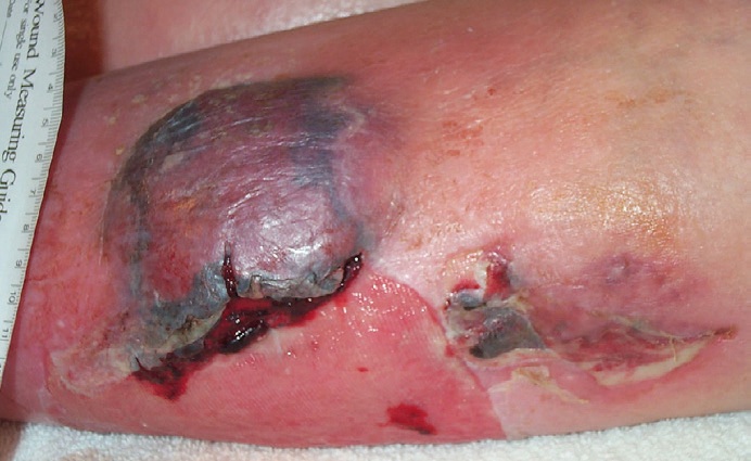 Bleeding haematoma
