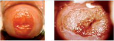 Cervical Ectropion