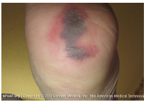 Suspected deep tissue injury