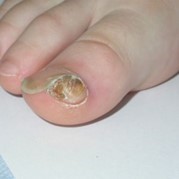 Exotosis