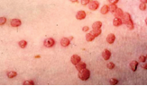 Extensive molluscum in immunosuppressed image