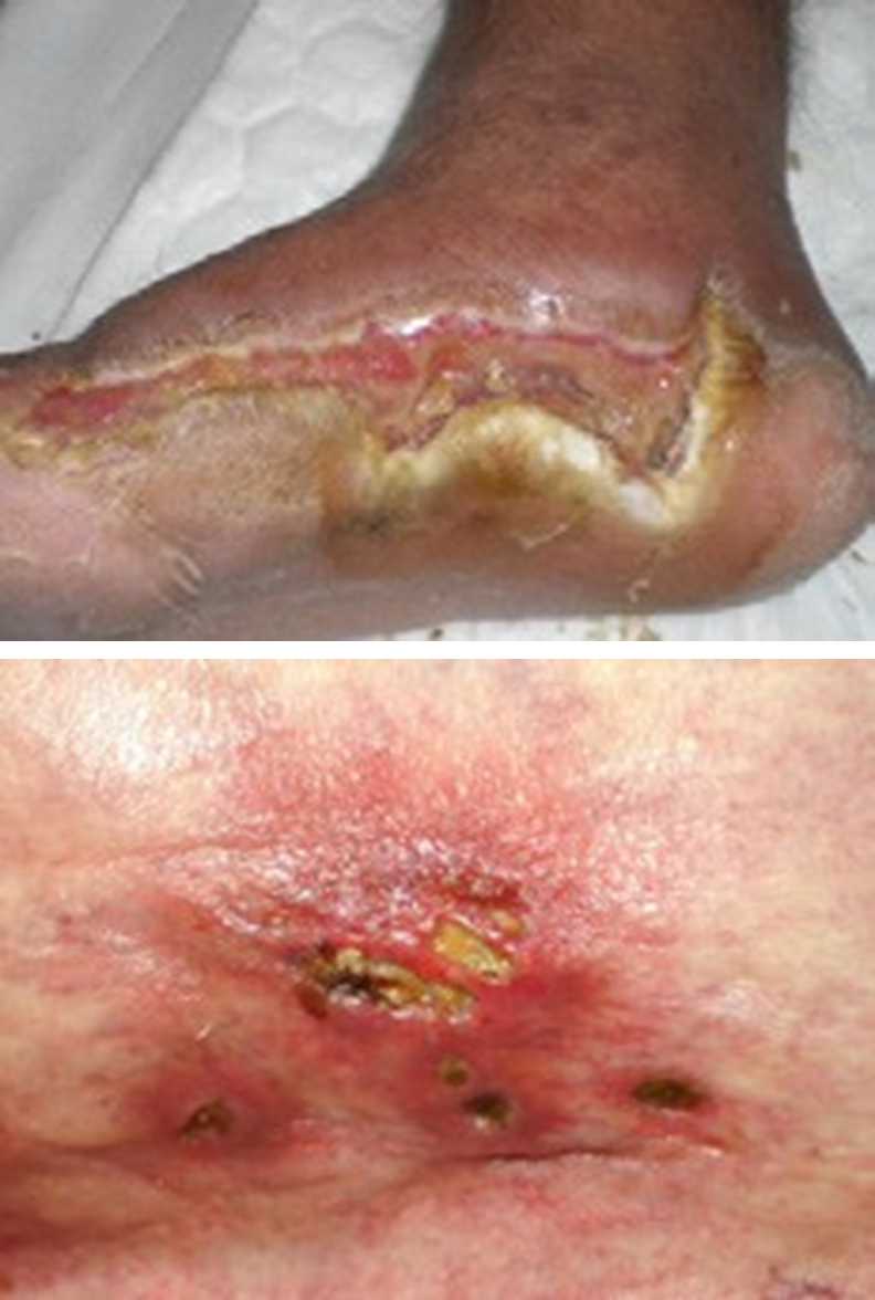 Infection