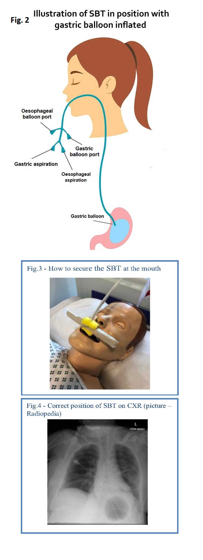Fig. 2 Illustration of SBT in position with gastric balloon inflated Fig. 3 How to secure the SBT at the mouth Fig. 4 Correct position of SBT on CXR